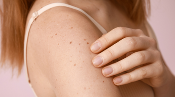 immagine con una donna che mostra la spalla pigmentata